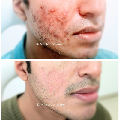 Acne treatment by laser In Nashik