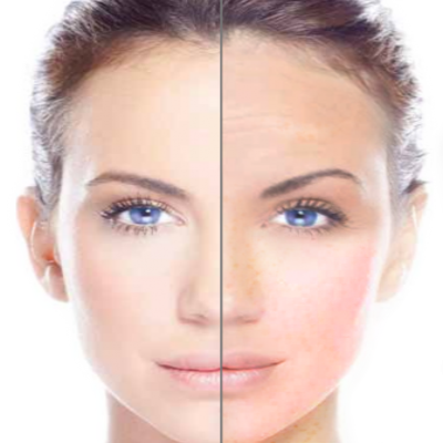 Hydrafacial in nashik