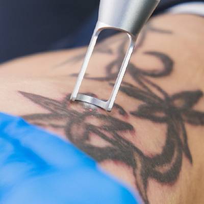 Tattoo Removal in Nashik